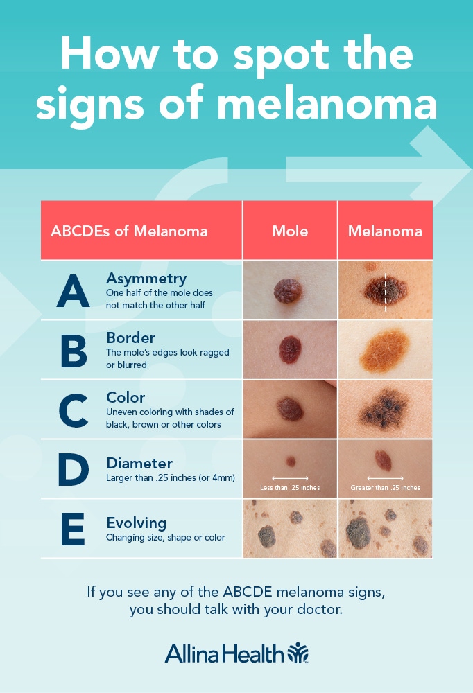 What Melanoma Looks Like infographic 1 1 – TodayHeadline
