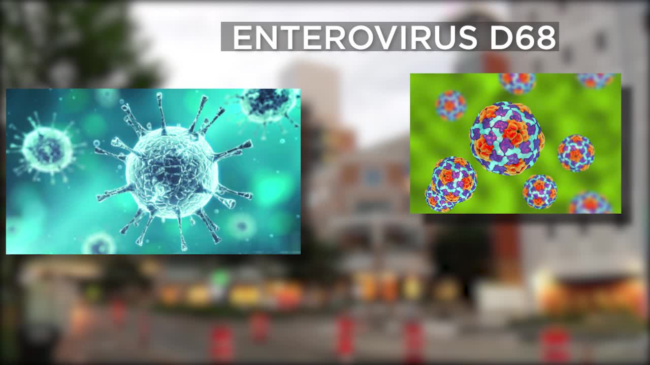 Enterovirus cases rising in children across the Twin Cities - KSTP