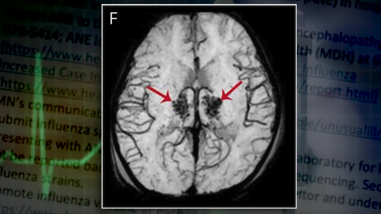 Flu Alert: Rare Neurological Condition Sparks Warning from State Health Officials